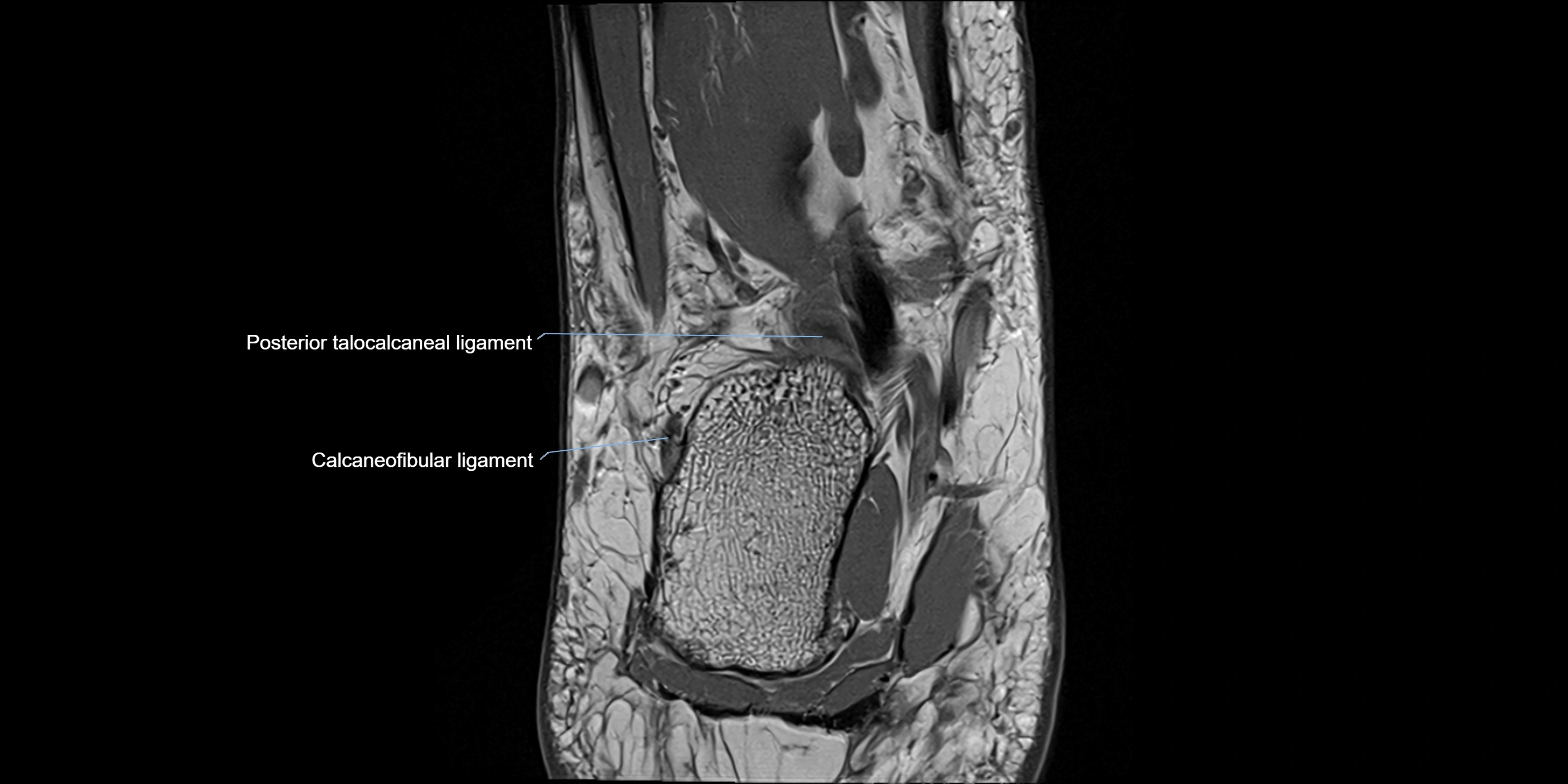 MRI Ankle coronal ligaments cross sectional anatomy 3T  radiology  image-img-00001-00020.webp